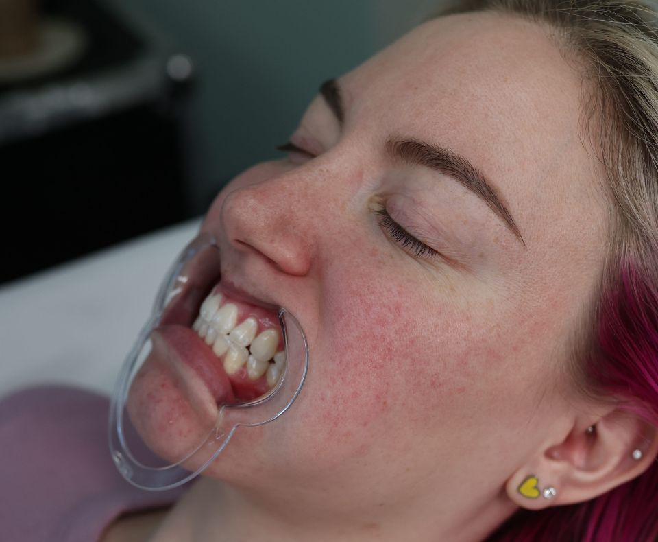 Summer Days Teeth Whitening Cary